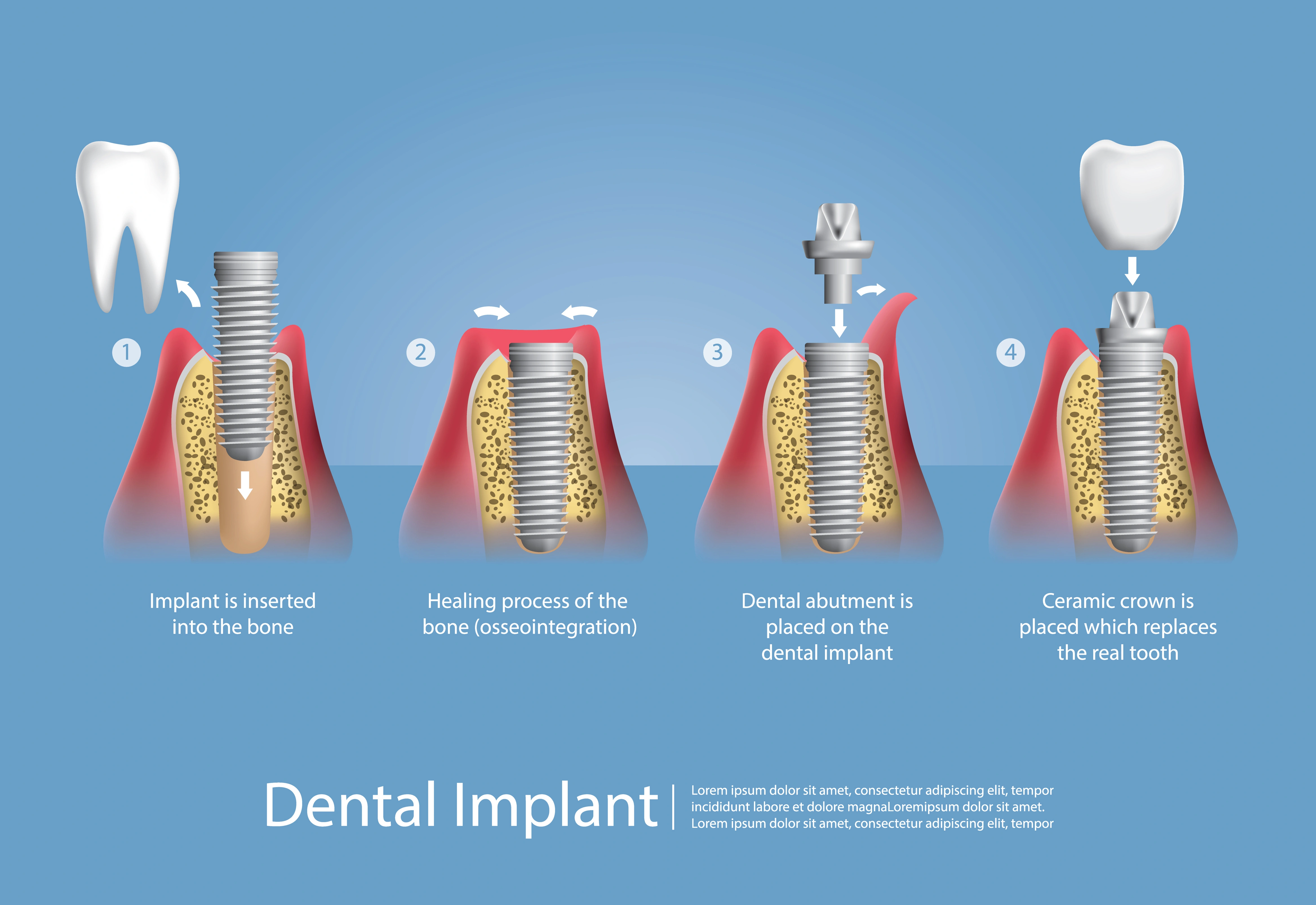 The chart shows four stages of getting a dental implant from surgical insertion to healing and placing the abutment with the crown