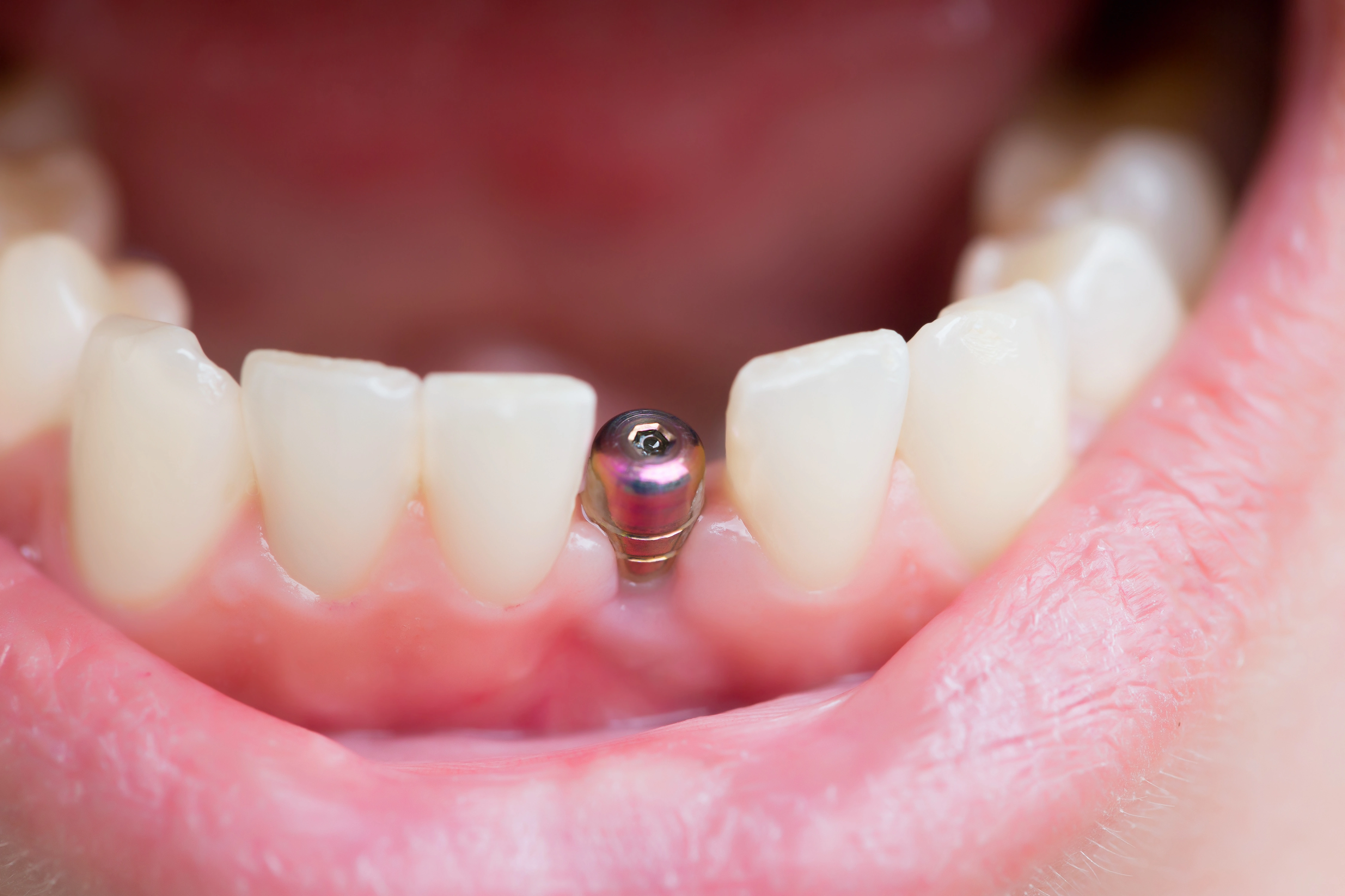 A close-up of a dental implant abutment visible between natural teeth, ready for the placement of a crown.