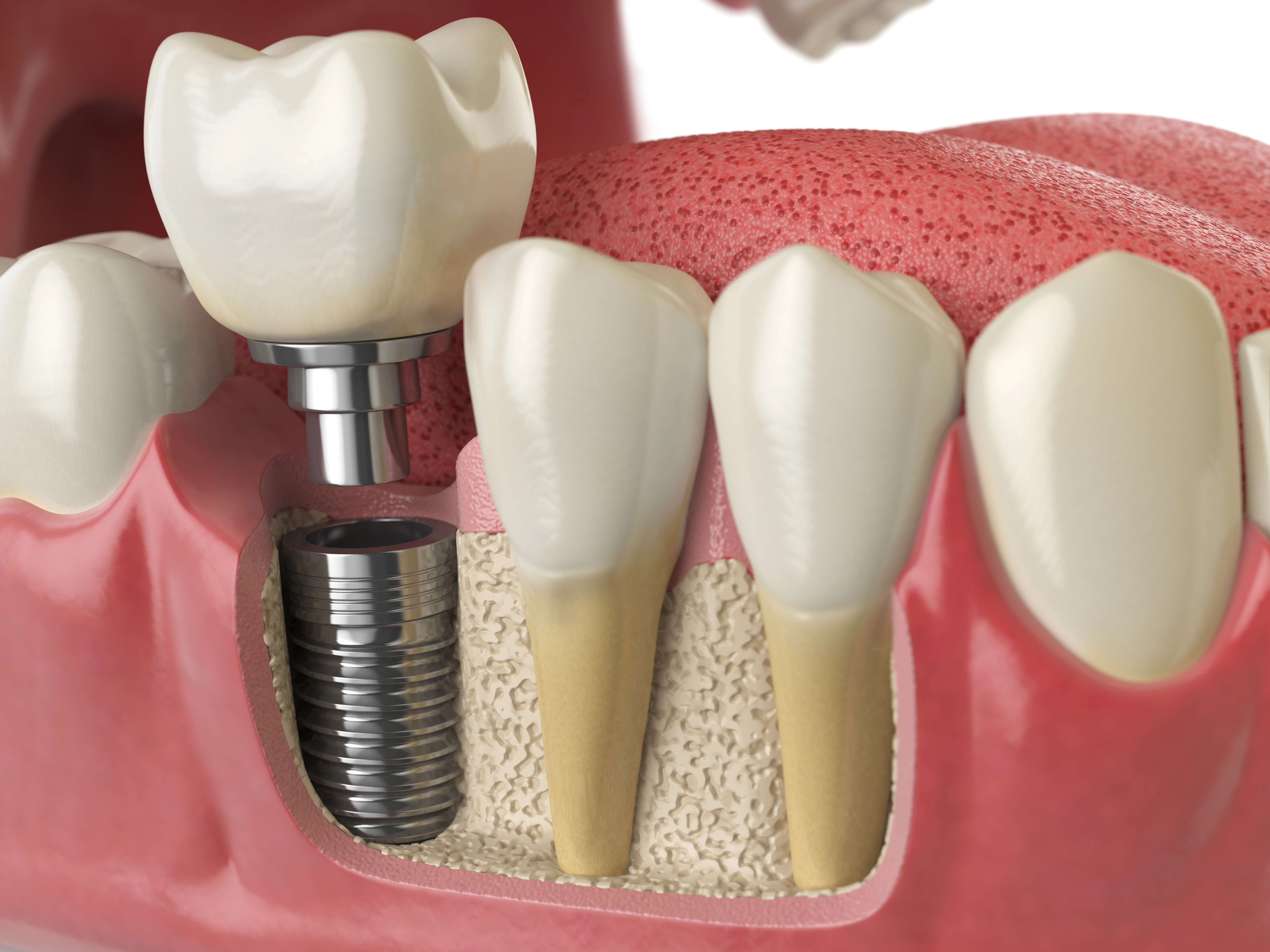 A 3D illustration of a dental implant inserted into the jawbone, showing the structure of the implant, the surrounding gum tissue, & adjacent natural teeth.