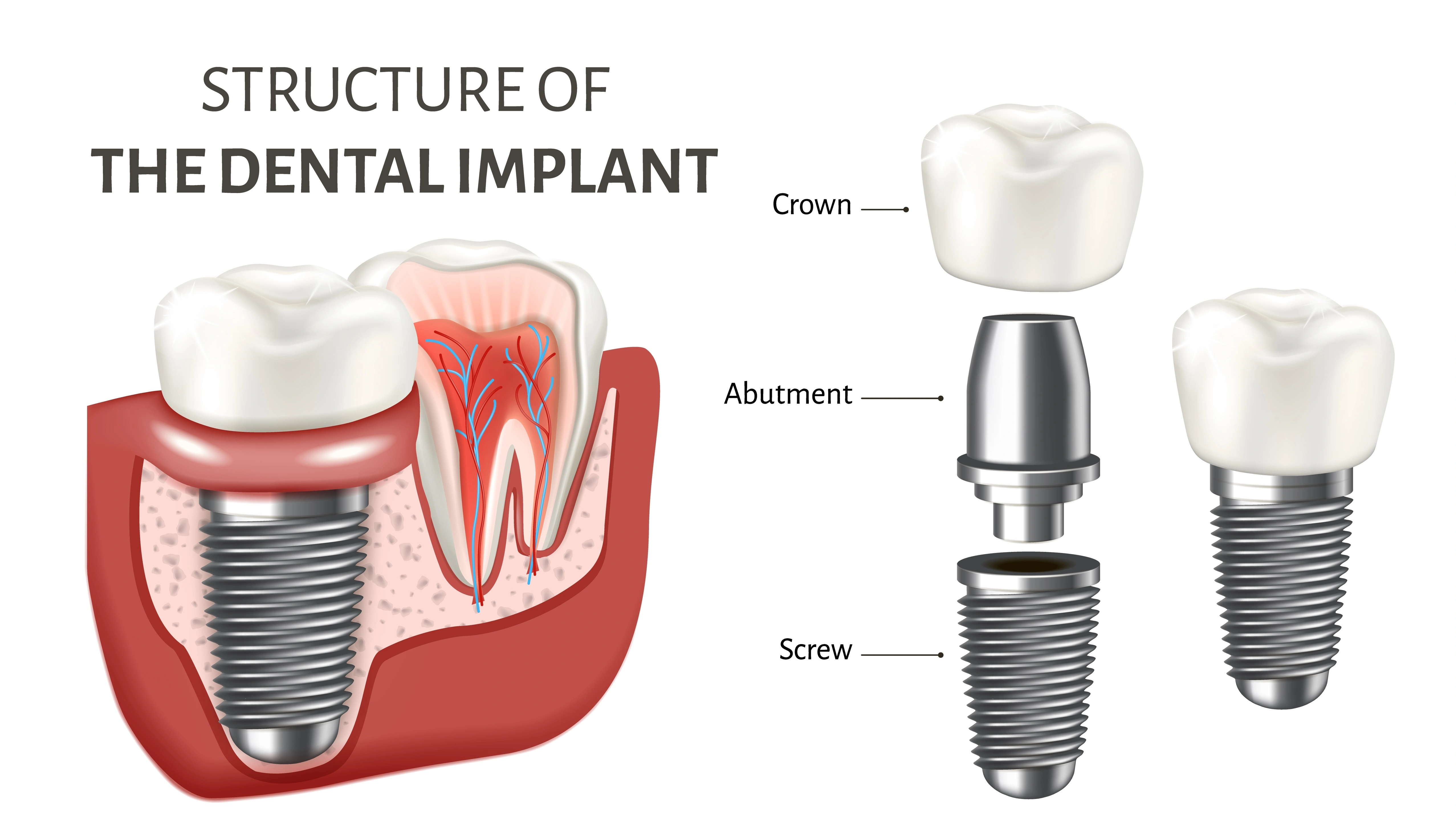 An infographic details the structure of a dental implant, showing the crown, abutment, and screw alongside a cross-sectional view of the implant within the gum and bone.