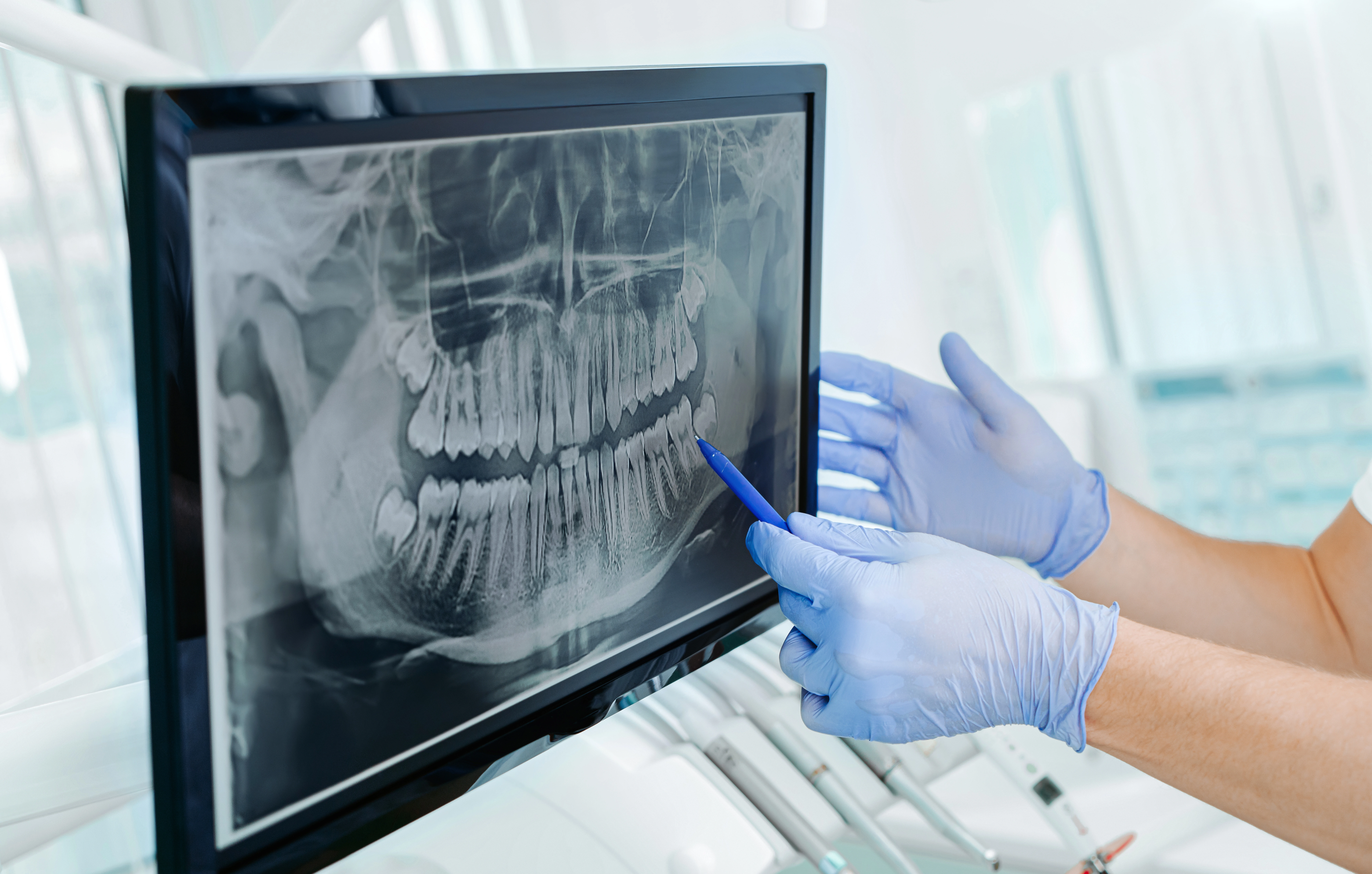 how an x-ray of a patient’s teeth on a screen in the dental practice