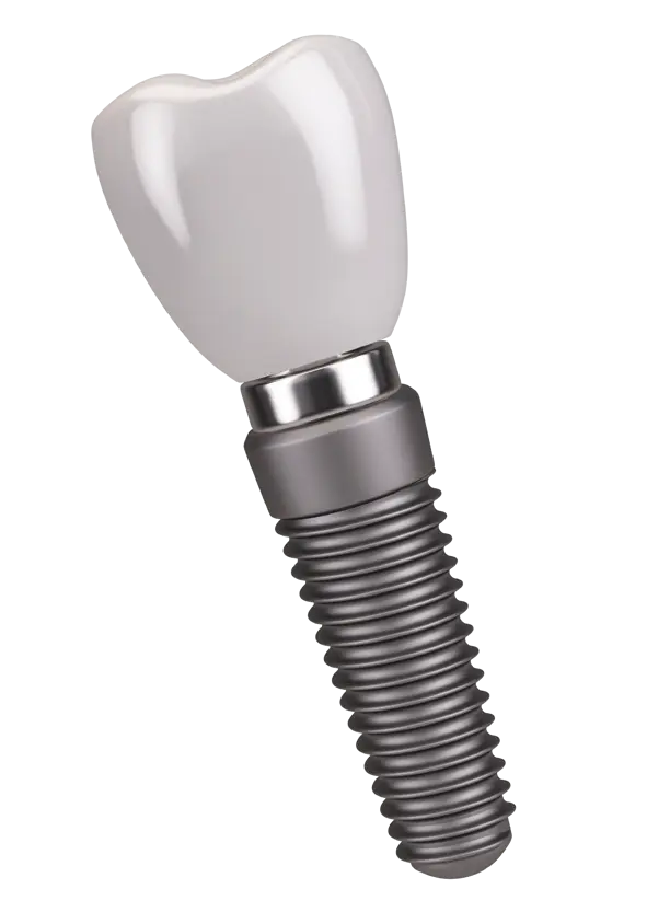 Single Tooth Implant With Crown