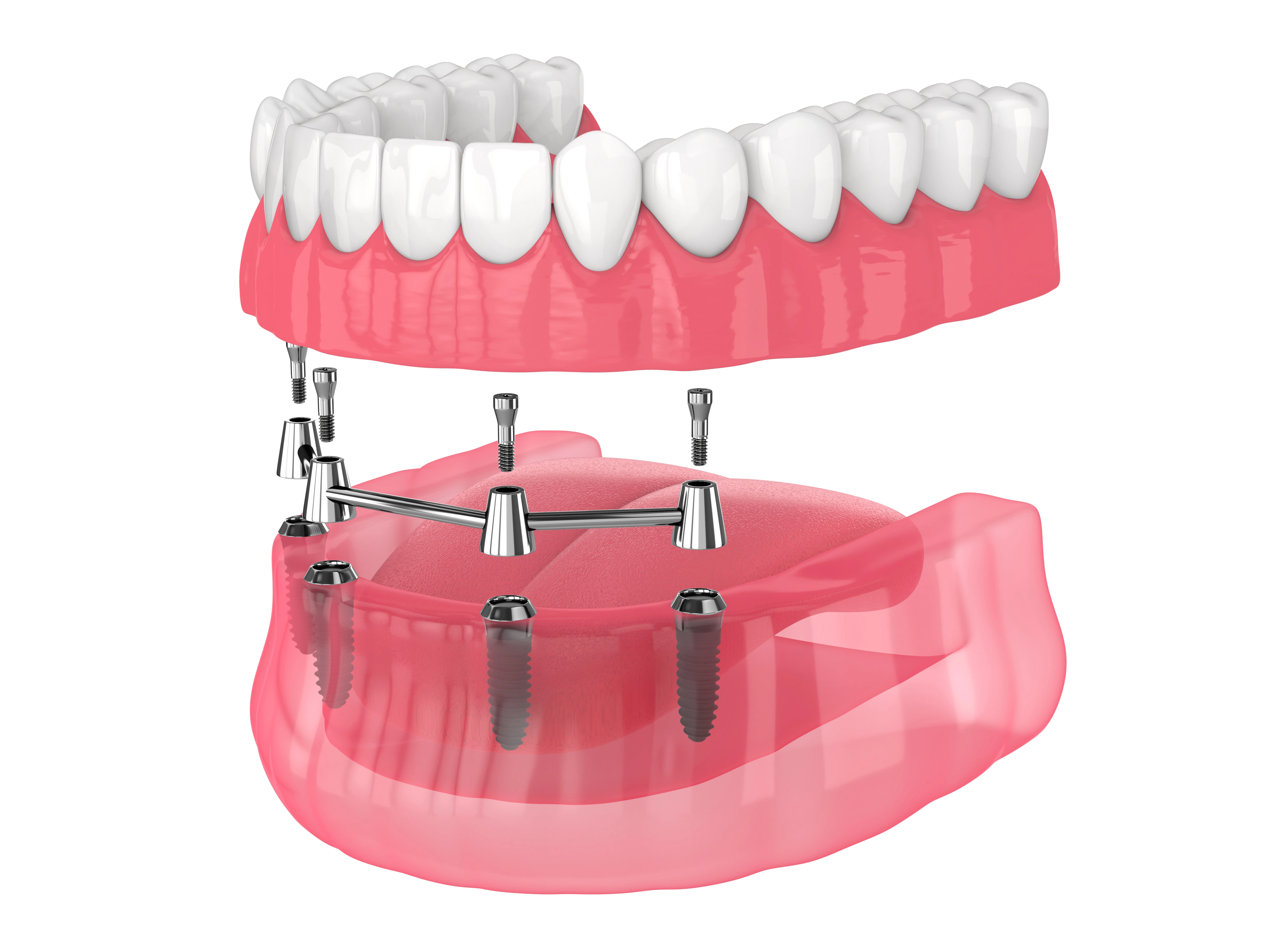 A 3D rendering of an implant-supported lower denture system shows the lower denture attached to several dental implants, illustrating how implants provide stability for dentures.