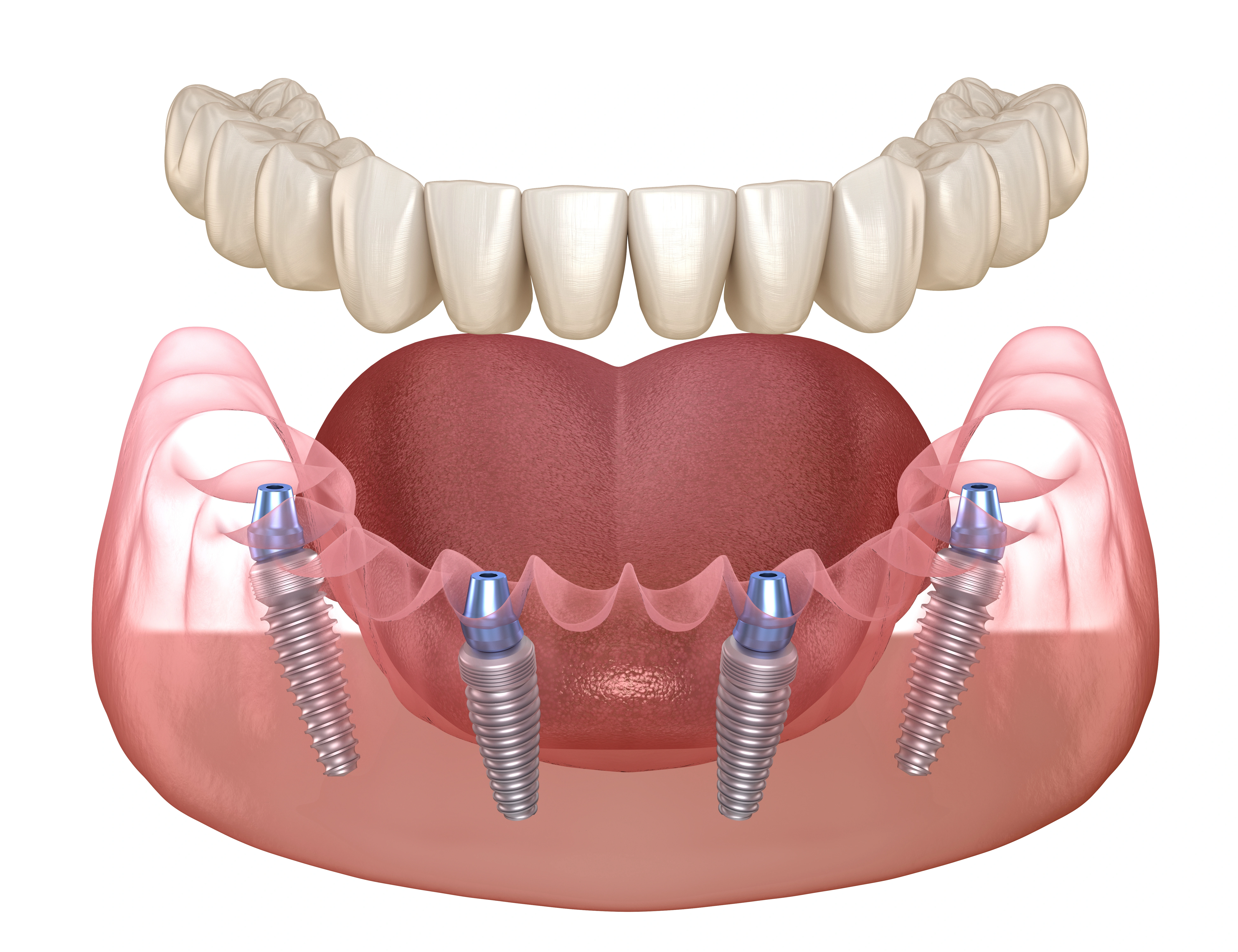 A diagram of an All on 4 system supported by implants on the lower jaw