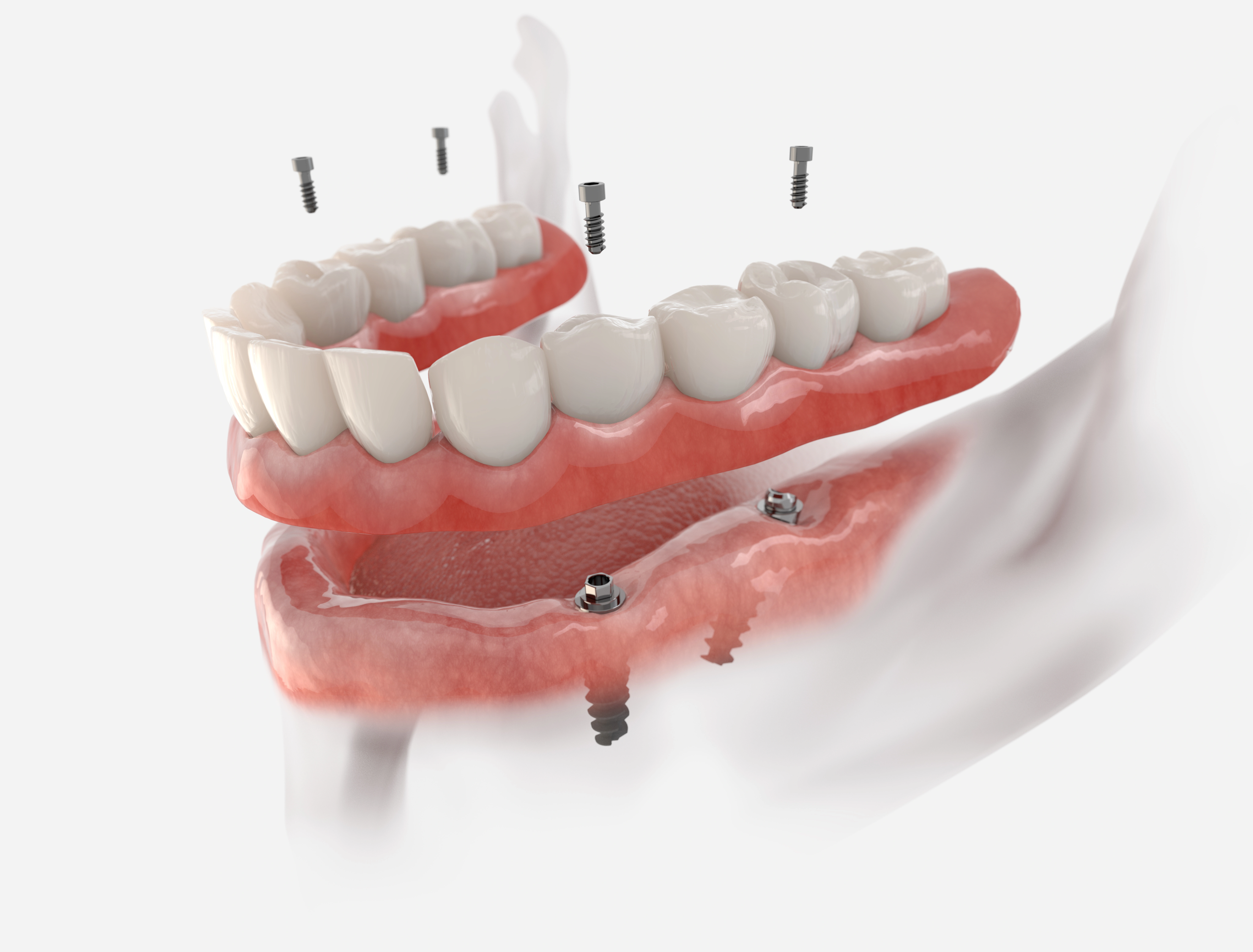 3D illustration of four dental implants holding a snap-in denture