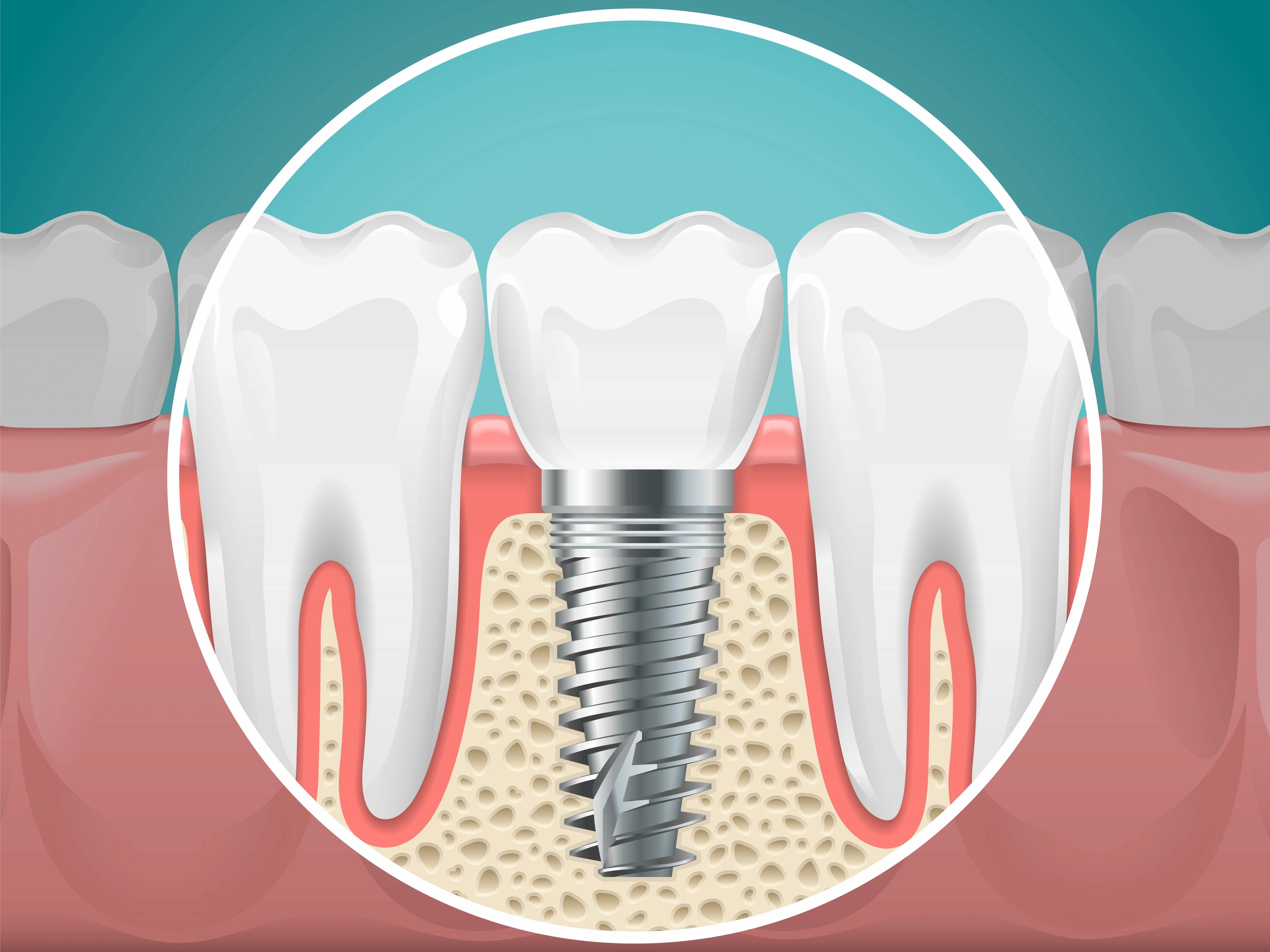 Illustration of a dental implant between two natural teeth showing how it is implanted under the gum to the jawbone.