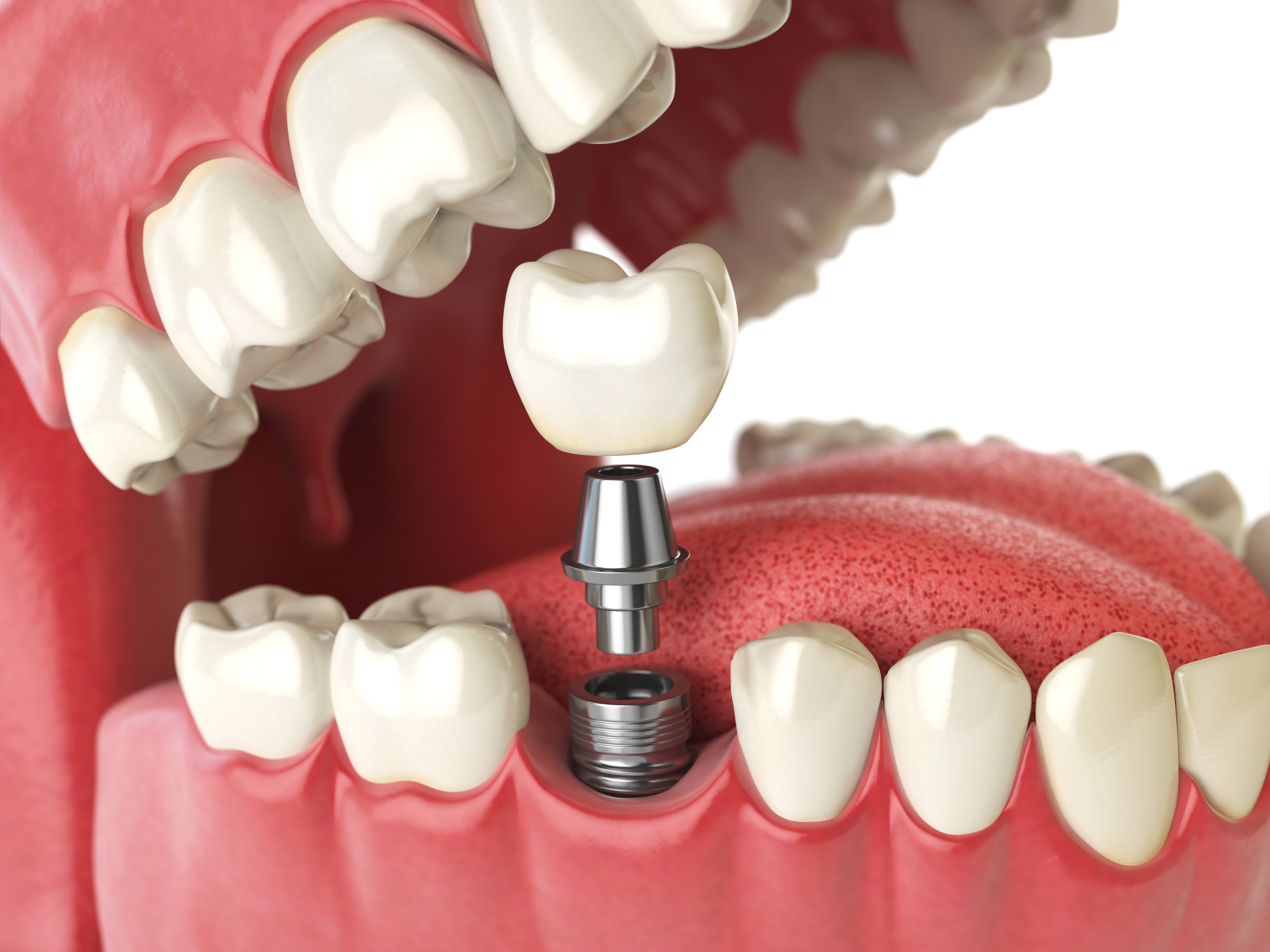A detailed 3D rendering shows the components of a dental implant, including the implant screw, abutment, and crown, aligned for placement in the gum.