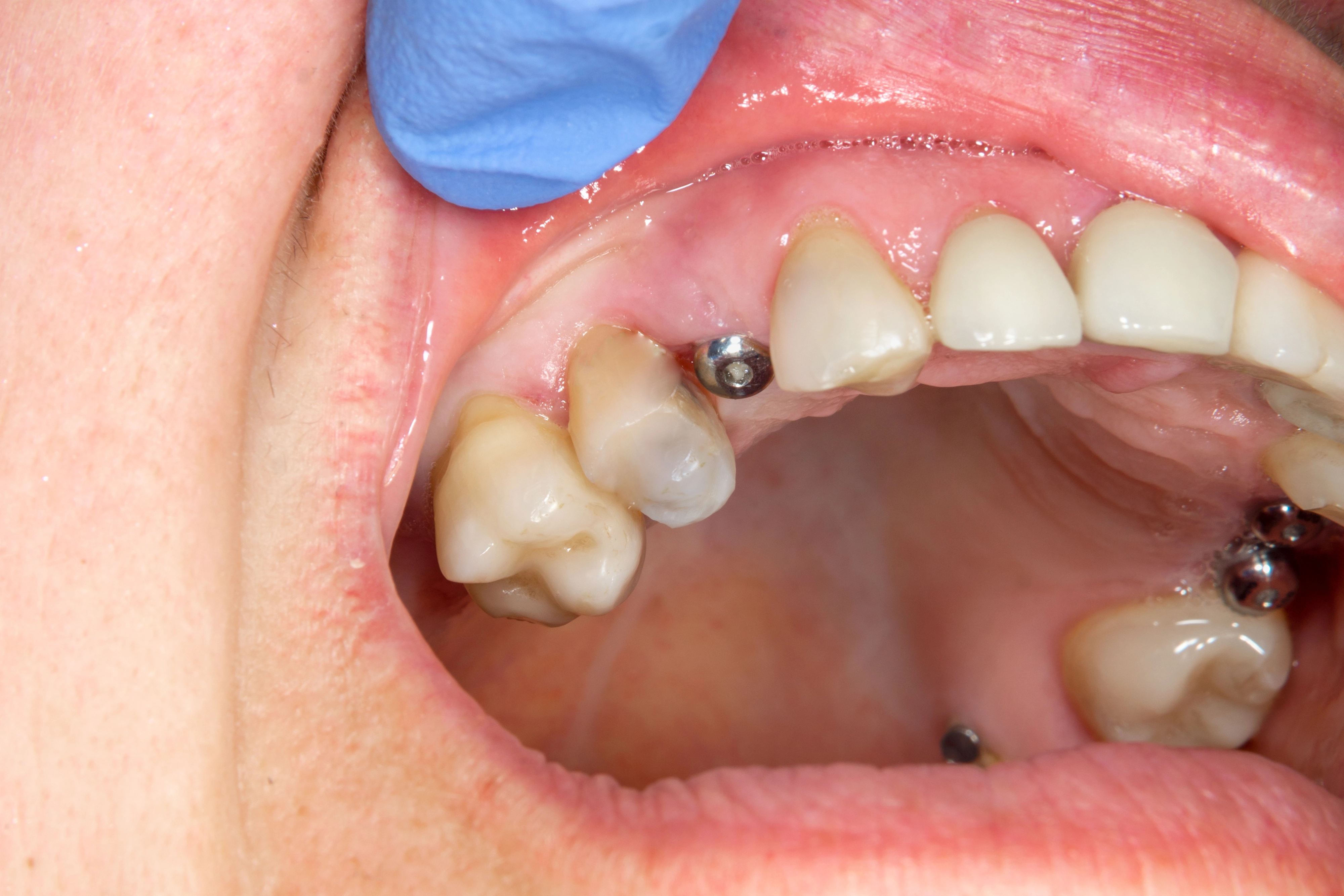 close up of a dental implant