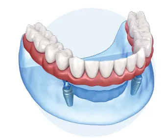 SnapSecure Implant Package - for Lower Arch